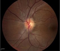 Mild Papilledema grade 1