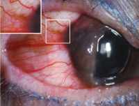 Conjunctival melanoma of mixed pigmentation. Slit-lamp photograph of a 41-year-old man with a nodular, thickened conjunctival mass with amelanotic and melanotic areas and a prominent feeder vessel superotemporally. Systemic workup revealed distant metastases.