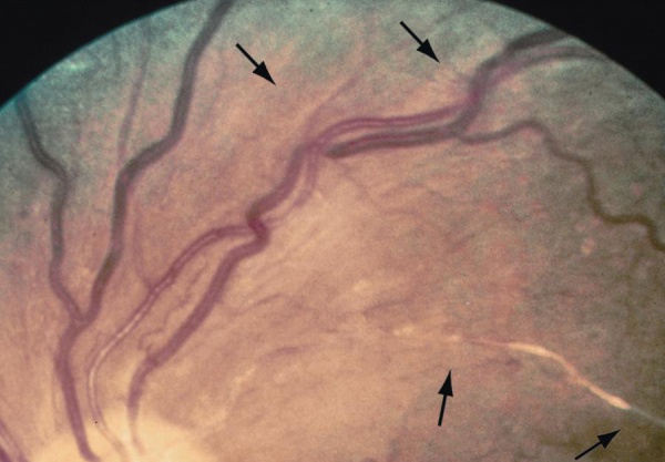 Hypertensive Retinopathy Eyewiki