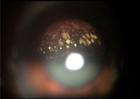 Asteroid hyalosis. Yellowish-white viterous opacities