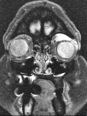 Orbital plasmacytoma MRI 2.JPG