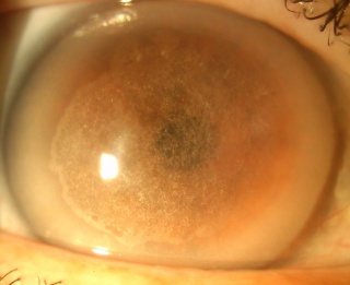 Elderly patient with advance distrophy. (Corneal crystals, midperipheral stromal haze and arcus lipoides)