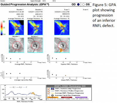 Figure 5 SD-OCT.png