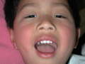 Figure 5. 4-year-old male with severe blepharoptosis of the right upper eyelid with a Marcus Gunn wink before and jaw movement. Photo urtesy of Rona Z. Silkiss, MD, FACS