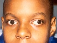 Exotropia, left eye (child)