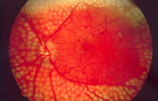 Fundus photo showing scatter laser surgery for diabetic retinopathy EDA09.JPG