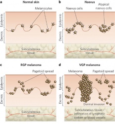 There are various stages of melanocytic lesion, each of which is marked by a new clone of cells with growth advantages over the surrounding tissues. a. Normal skin. This shows an even distribution of dendritic melanocytes within the basal layer of the epidermis. b. Naevus. In the early stages, benign melanocytic naevi occur with increased numbers of dendritic melanocytes. According to their localization, naevi are termed either junctional, dermal or compound. Some naevi are dysplastic, with morphologically atypical melanocytes. c. Radial-growth-phase (RGP) melanoma. This is considered to be the primary malignant stage. d. Vertical-growth-phase (VGP) melanoma. This is the first stage that is considered to have malignant potential and leads directly to metastatic malignant melanoma, the most deadly stage, by infiltration of the vascular and lymphatic systems. Pagetoid spread describes the upward migration or vertical stacking of melanocytes that is a histological characteristic of melanoma. Reprinted by permission from Macmillan Publishers Ltd: Nature Publishing Group. Gray-Schopfer et al. Melanoma biology and new targeted therapy. Nature 445, 851-857(22 February 2007)