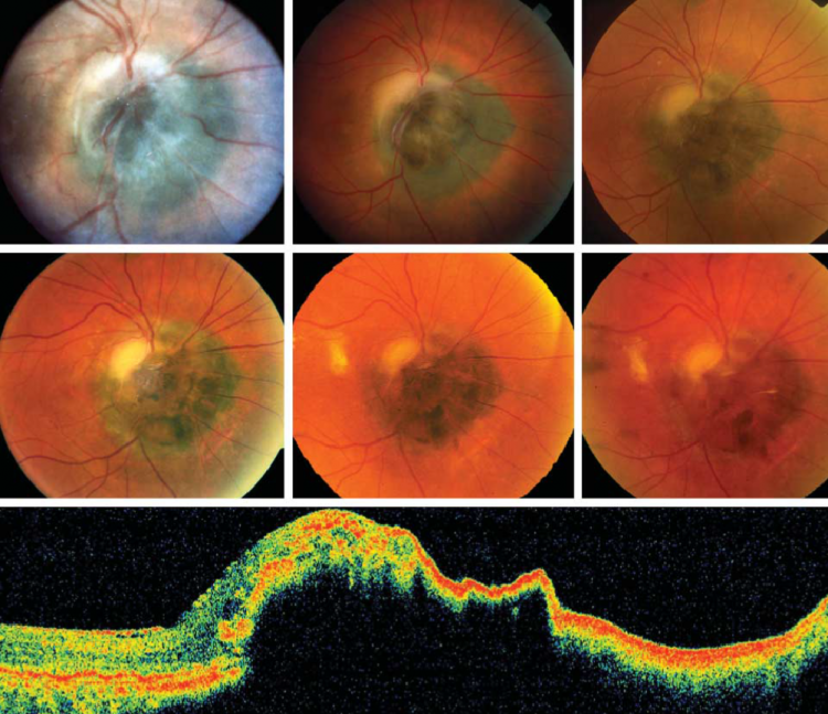 Optic Disk Melanocytoma And Optical Coherence Tomography Angiography Oct A Eyewiki 3003