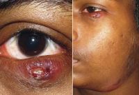 Left lower eyelid wound with submandibular lymphadenitis. A, Patient presented with swollen, erythematous left lower eyelid with delayed eyelid wound healing after 1 week of incision and curettage. B, Fluctuant, tender submandibular swelling (arrowhead, marked) that developed within a short duration of 1 week after the first follow-up.