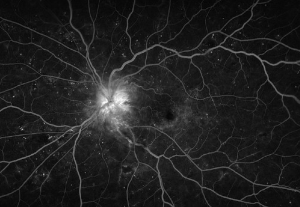 Fluorescein angiogram of a 62-year-old female. Image depicts significant disc leakage secondary to disc edema with no neovascularization. Scattered microaneurysms in the setting of known diabetic retinopathy. (Image courtesy of Mohammad Amr Sabbagh, MD and Monique Munro, MD, FRCSC)