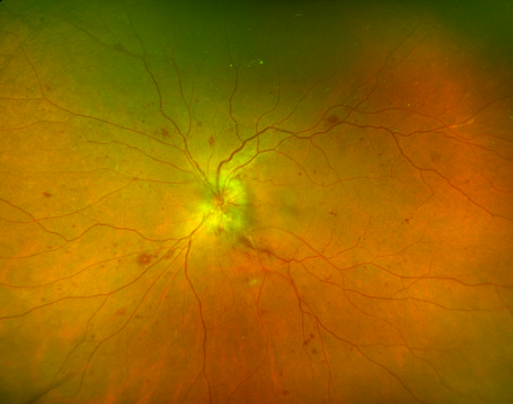 Optos widefield image of a 62-year-old female depicting significant disc edema and macular thickening surrounded by diabetic retinal changes (Image courtesy of Mohammad Amr Sabbagh, MD and Monique Munro, MD, FRCSC).