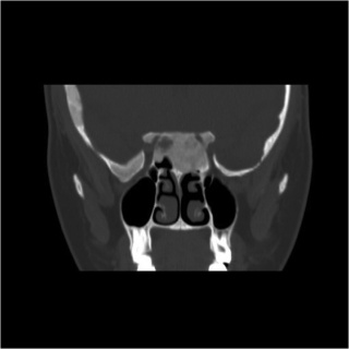 Figure 1. Bony optic nerve encasement in craniofacial fibrous dysplasia.