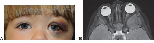 Courtesy of Bobby S. Korn, MD, PhD. Accessed at AAO.org on Aug 25,2020.A. Metastatic left orbital neuroblastoma. B. MRI orbits T2 sequence with fat suppression, shows a large infiltrating lesion of the left sphenoid wing invading orbital soft tissues and temporal fossa.