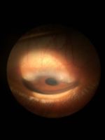 Trantas dots represent collection of eosinophills in case of Limbal Vernal Keratoconjunctivitis.