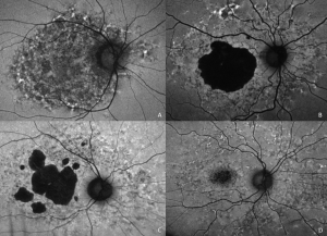 Most cases of pentosan polysulfate maculopathy that involve the peripapillary retina, demonstrate a hypoautofluorescent peripapillary ring (A). The autofluorescent signal is spared in many inherited macular dystrophies such as this dominant macular dystrophy associated with a variant of unknown significance in the ELOVL4 gene (B), another macular dystrophy associated with a disease-causing PRPH2 variant (C), and two disease-causing ABCA4 variants (D).