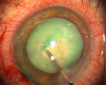 Cataract watermarked.jpg