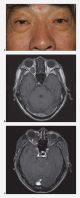 Cavernous hemangioma. a. Normal exam and appearance. b, c. Axial MRI images demonstrate a well encapsulated, heterogeneously enhancing intraconal tumor in the right orbit. MRI findings of T1 hypointensity, and T2 hyperintensity, are useful in the differential diagnosis from neurofibroma, neurilemmoma, or hemangiopericytomas (these tumors share similar imaging characteristics on CT)