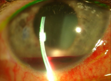 Figure 16: postoperative complication - hyphema