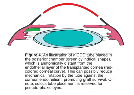 Sulcus Tube Placement IOL Eye...png