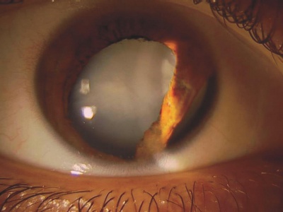 Traumatic Cataract