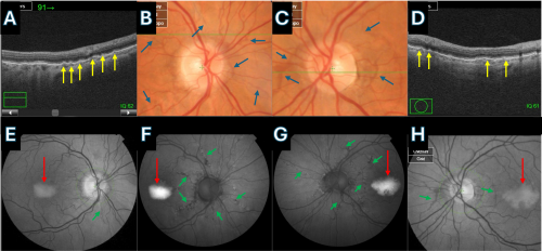 Angioid streaks