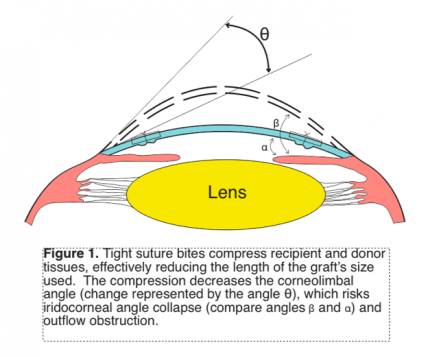 Effect of Suture Bite in PKP.png