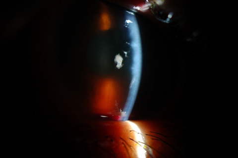 Figure 2. Slit-beam photo with hyphema visible within the inferior anterior chamber. (Same eye as Figure 1)