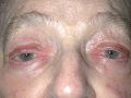 Figure 8. 85-year-old female with severe bilateral blepharoptosis before and after frontalis sling surgery. Photo courtesy of Rona Z. Silkiss, MD, FACS