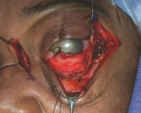 Surgical approach to the orbit combining lateral canthotomy/cantholysis, inferior transconjunctival incision, and medial Lynch (frontoethmoidal) incision. Lateral orbital rim bone removed.