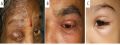 Lid edema in patients with (A) herpes zoster ophthalmicus, (B) blister beetle dermatitis, (C) insect bite