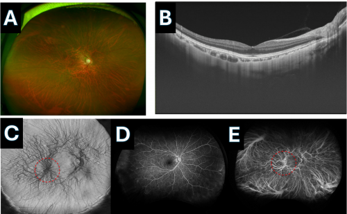 Posterior Vortex Vein or Macular Vortex Vein