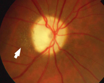 Neuroretinitis Irregular Star.png