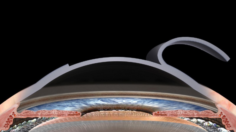 Figure 1. Lifting of LASIK flap.