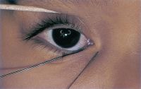 Congenital lacrimal–cutaneous fistula draining to the skin surface.