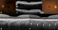 A 58-year-old woman with diffuse unilateral melanocytosis affecting the left eye (A) and normal clinical findings in the right eye (D). B, C, Horizontal optical coherence tomography (OCT) scans through the fovea show bilaterally a normal retina with no view of the sclerochoroidal interface in the study eye (B). Magnification of OCT scans shows a thickened choroid in the study eye (E) compared with the opposite eye (F, white arrows: sclerochoroidal junction).