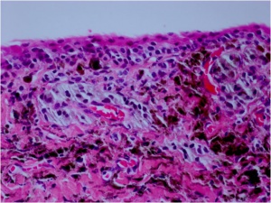 Fig. 1C - conj combined nevus path 2.jpg