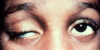 Congenital ptosis