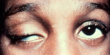 Congenital ptosis