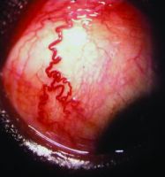 "Arterialized” episcleral vessels