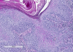 Actinic keratosis 7.0 x PAS.jpg