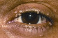 Molluscum contagiosum lesions on eyelid