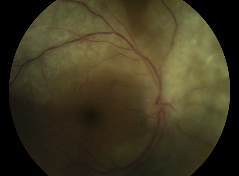 Syphilitic retinitis