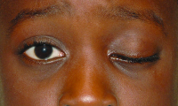 Amblyogenic ptosis, left eye.