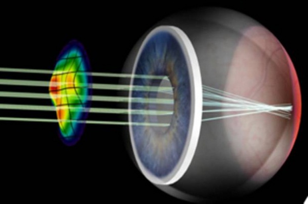 Figure 4. Schematic of wavefront technology, showing a wavefront pattern.