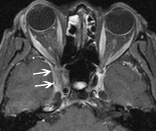 Figure 7: MRI, fat-saturated, T1-weighted image with white arrows showing extension into the cavernous sinus. Courtesy of Z.X. Ding