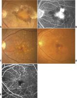 Fundus photographs (A, C, D) and fluorescein (B) and indocyanine green (E) angiographies of typical nAMD (A, B), nnAMD (C), and PCV (D, E) in Japanese patients. nAMD neovascular AMD; nnAMD non-neovascular AMD; PCV polypoidal choroidal vasculopathy.