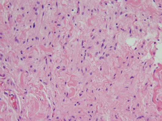 Orbital Neurofibroma - H&E.JPG