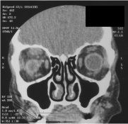 CT scan showing amyloidosis infiltration of the levator and superior rectus complex of the right eye.