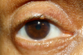 basal cell carcinoma (eyelid)