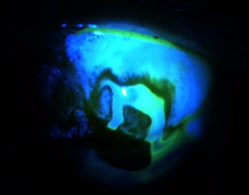 Slide 2. Image of a positive Seidel test. Note the fluorescence as the leak washes away the fluroscein stain.